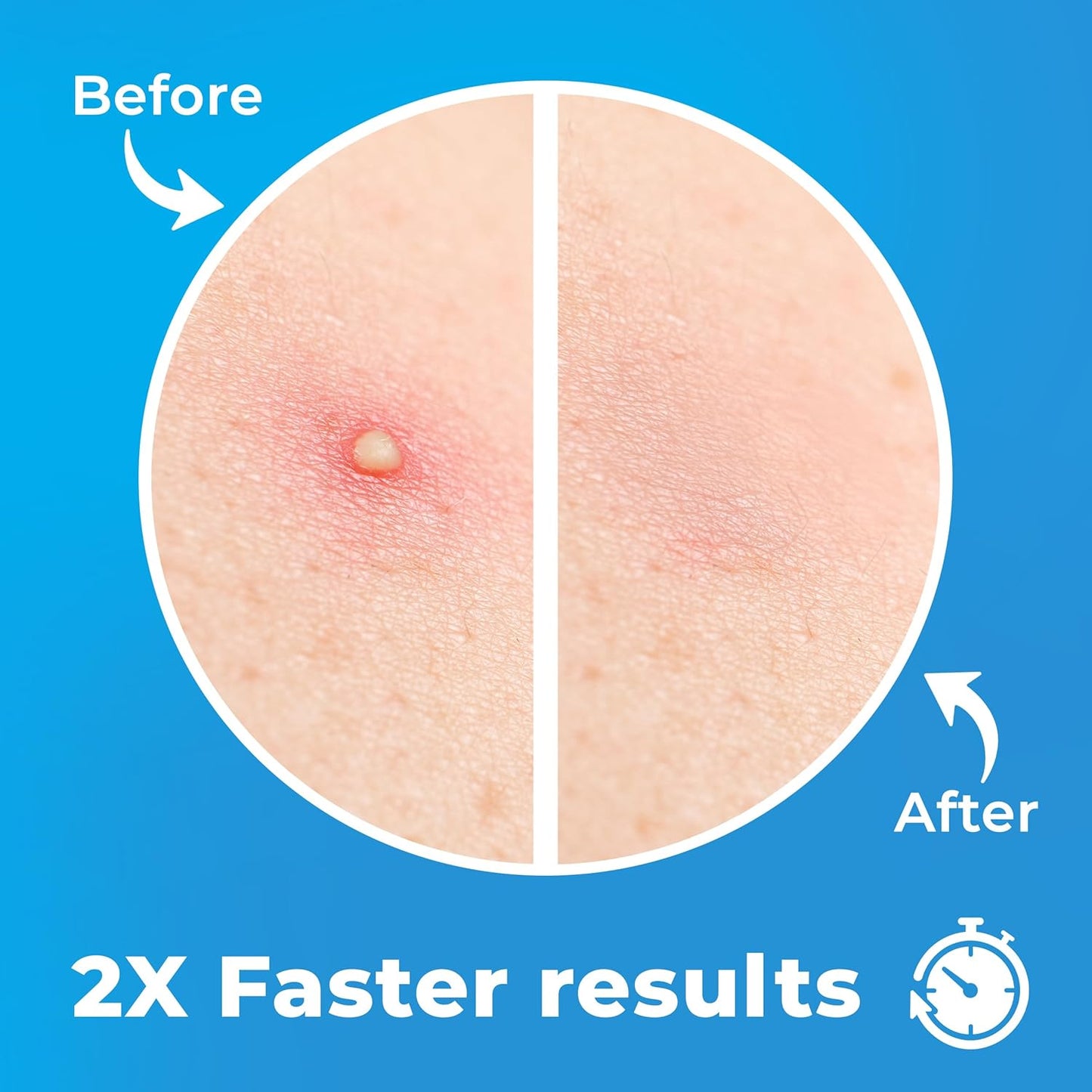 PatchRx Pimple Patches for Face (120 Patches), Hydrocolloid Pimple Patches - Pimple Patch Zit Patch and Pimple Stickers - Hydrocolloid Pimple Dots for Pimples - Zit Patches