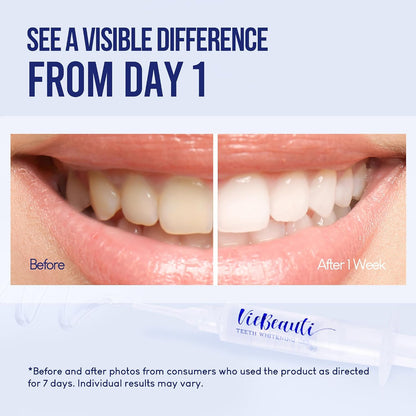 Teeth Whitening Kit with LED Light: VieBeauti Tooth Whitener for Sensitive Teeth - Removes Stains from Food Coffee Smoking Wine and Soda for a Bright Smile Coconut Flavor