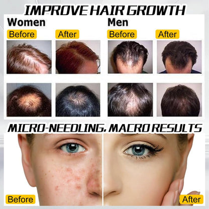 Microneedling Roller, 2Pack Derma Roller 0.5MM & 1MM for Women and Men, 540 Titanium Derma Roller for Hair Beard Facial Skin Face